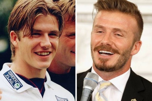 David Beckham denti rifatti