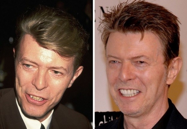 David Bowie denti rifatti