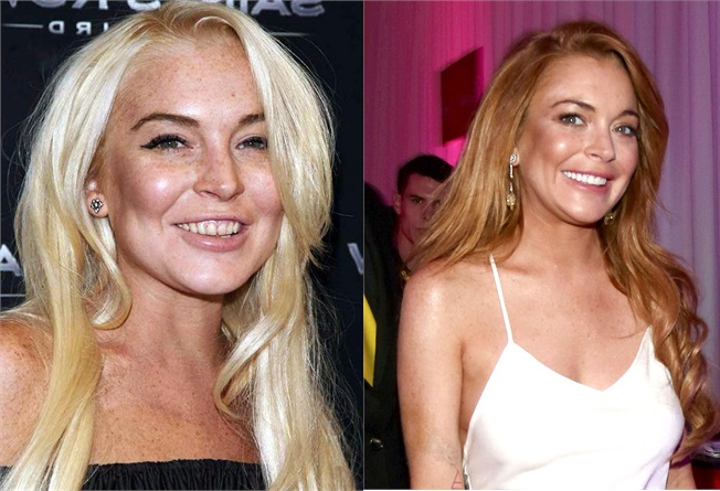 Lindsay Lohan denti rifatti